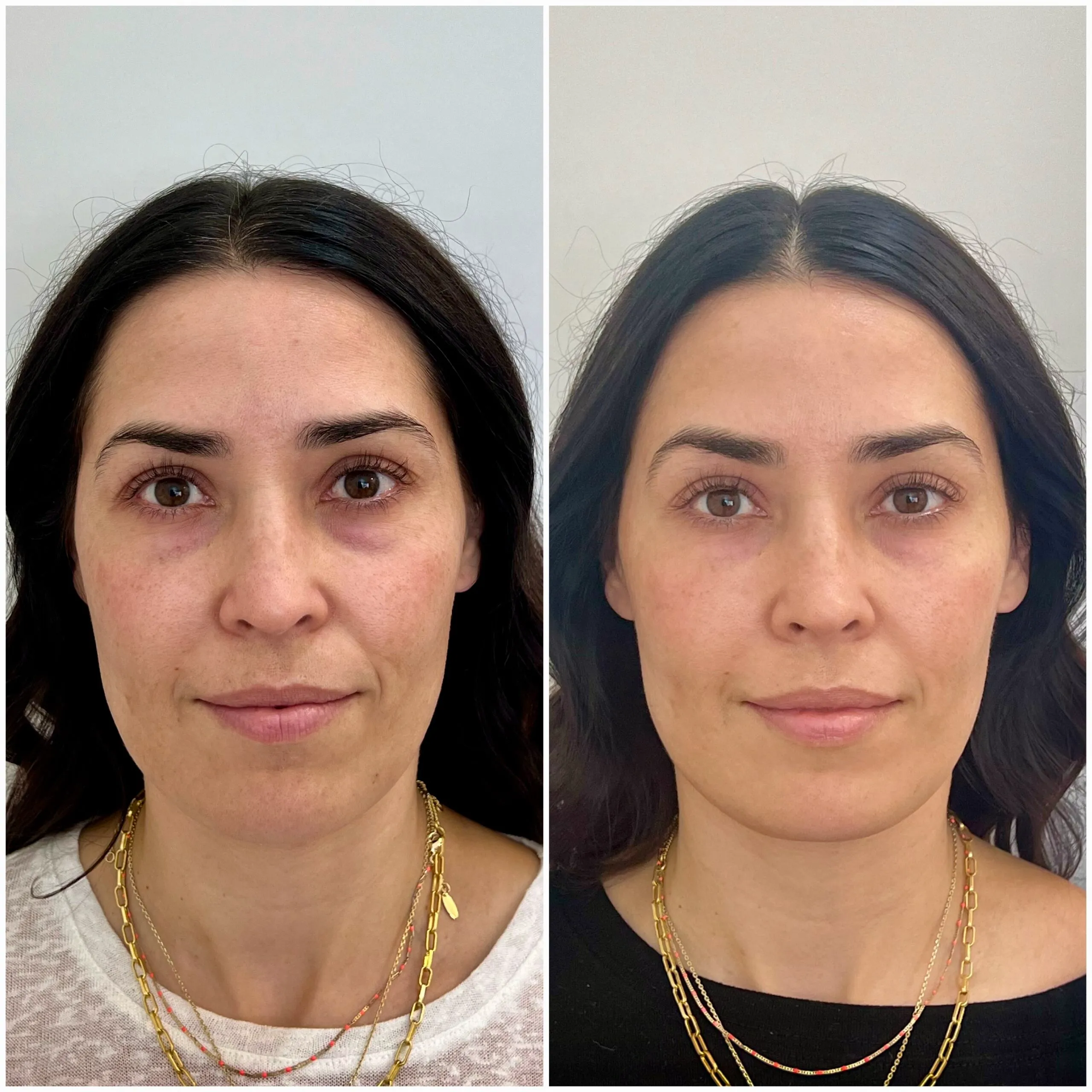 PRF Treatment Results